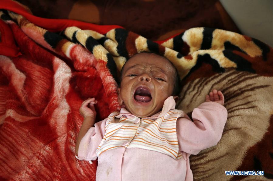 YEMEN-SANAA-CHILDREN-MALNUTRITION